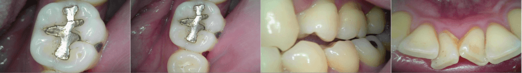 intraoral Camera IC Mode