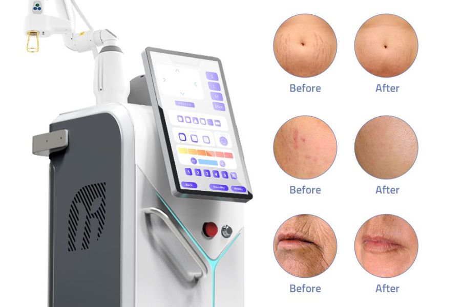 choosing fractional laser equipment UAE