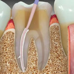 Sealapex Polymeric Calcium Hydroxide Root Canal Sealer - Image 6